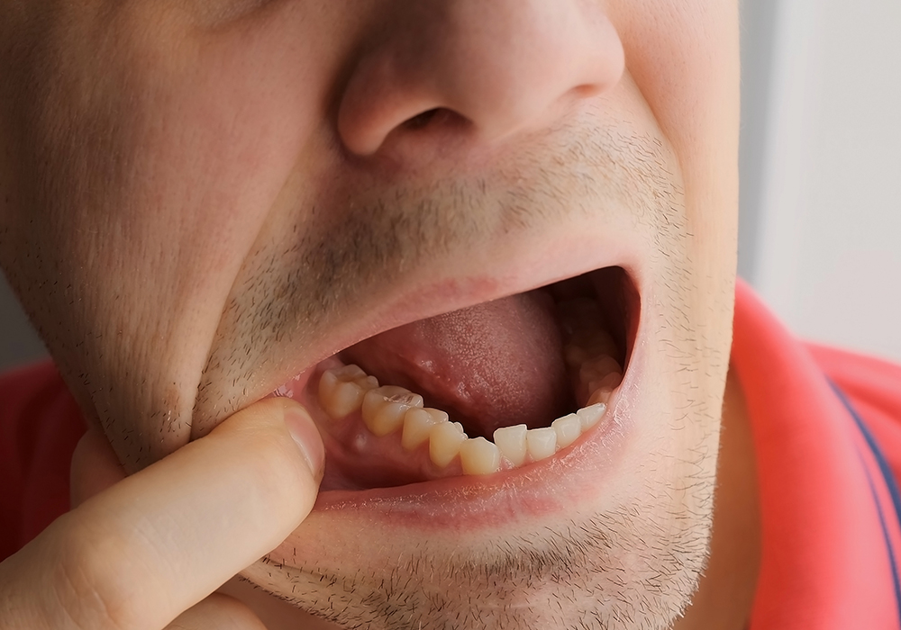 Close up of a man with an abscess tooth