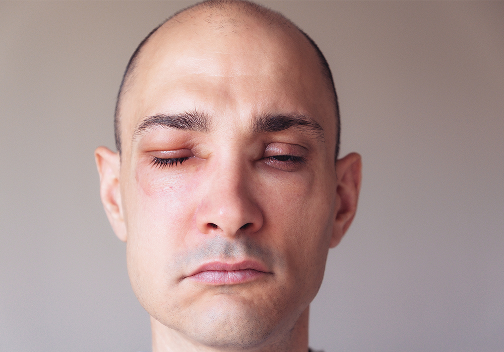 Man with swollen face