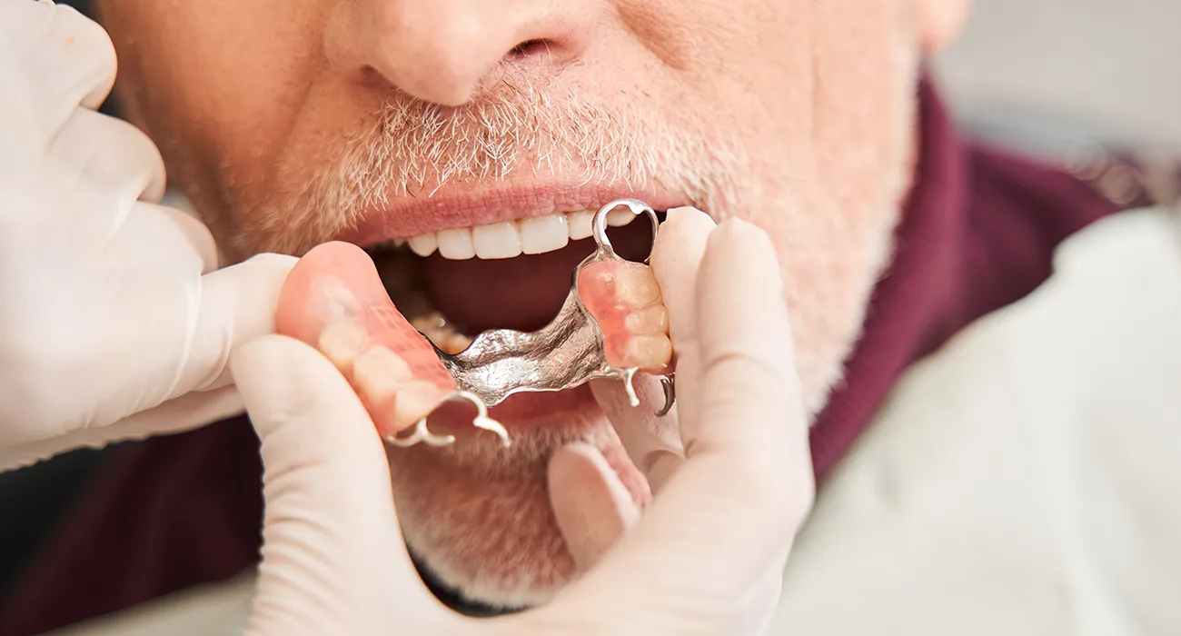 older man having dentures placed into mouth