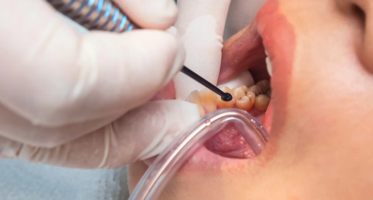 Dentist inspecting a patient’s mouth for cavities